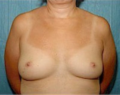 Breast Augmentation Before & After Gallery - Patient 5883247 - Image 1