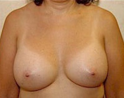 Breast Augmentation Before & After Gallery - Patient 5883247 - Image 2