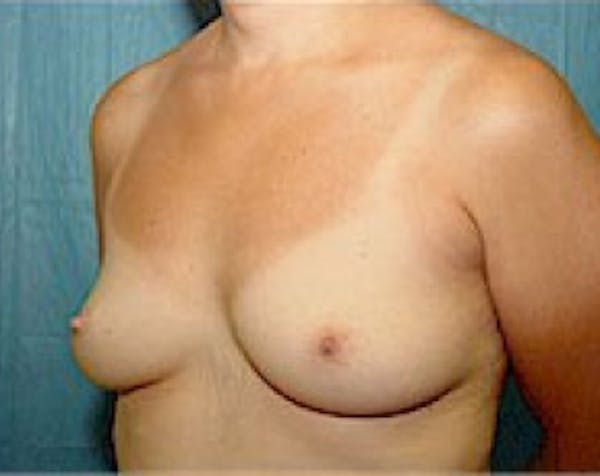 Breast Augmentation Before & After Gallery - Patient 5883247 - Image 3