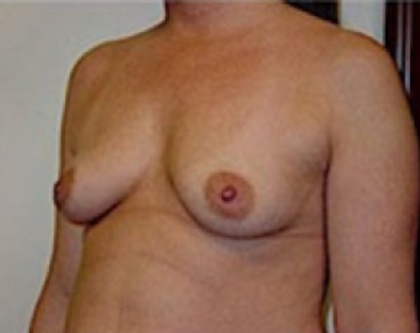Breast Augmentation Gallery - Patient 5883248 - Image 3