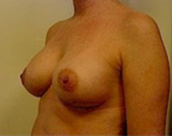 Breast Augmentation Before & After Gallery - Patient 5883248 - Image 4
