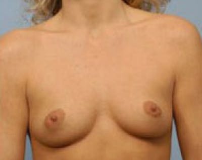 Breast Augmentation Before & After Gallery - Patient 5883250 - Image 1