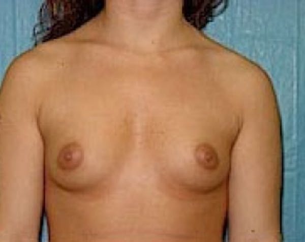 Breast Augmentation Before & After Gallery - Patient 5883253 - Image 1
