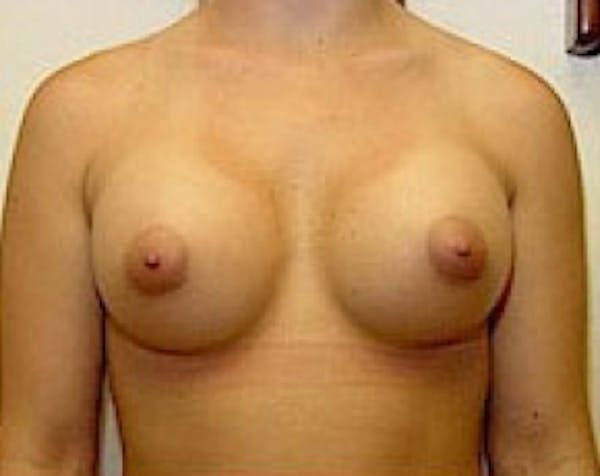 Breast Augmentation Before & After Gallery - Patient 5883253 - Image 2