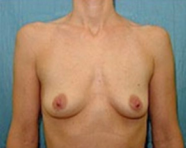 Breast Augmentation Before & After Gallery - Patient 5883254 - Image 1