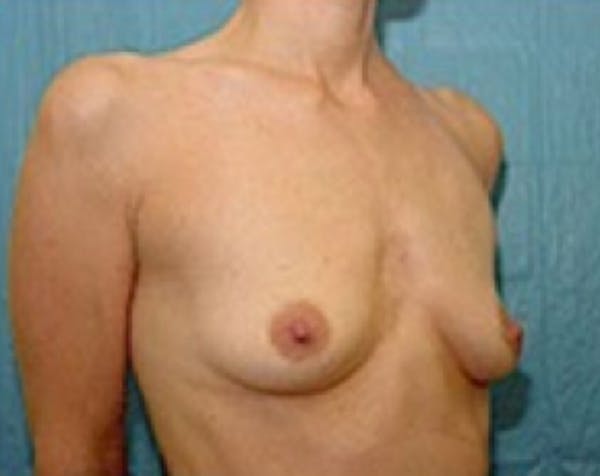 Breast Augmentation Before & After Gallery - Patient 5883254 - Image 3