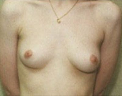 Breast Augmentation Before & After Gallery - Patient 5883261 - Image 1
