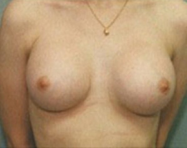 Breast Augmentation Before & After Gallery - Patient 5883261 - Image 2