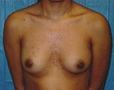 Breast Augmentation Before & After Gallery - Patient 5883262 - Image 1