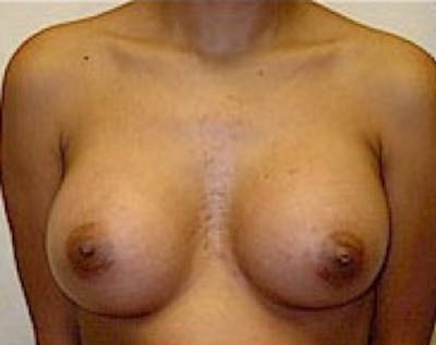 Breast Augmentation Before & After Gallery - Patient 5883262 - Image 2