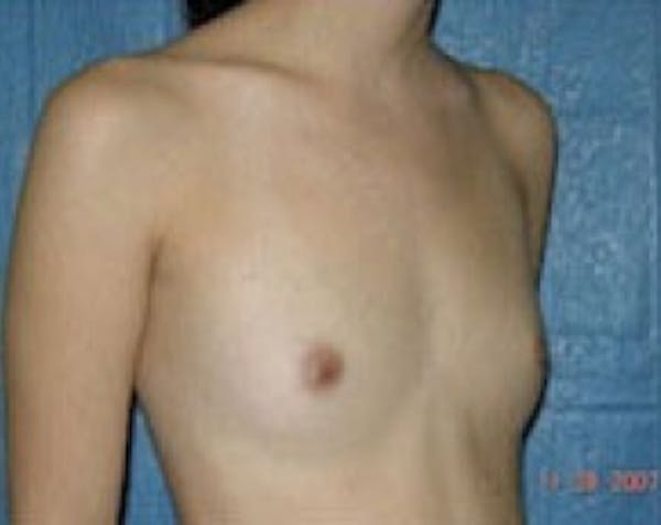 Breast Augmentation Before & After Gallery - Patient 5883268 - Image 1
