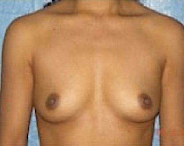 Breast Augmentation Before & After Gallery - Patient 5883270 - Image 1