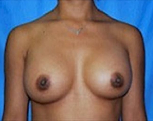 Breast Augmentation Before & After Gallery - Patient 5883270 - Image 2