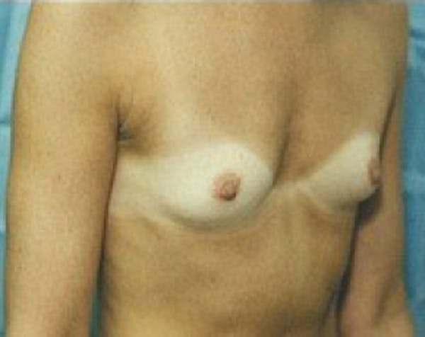 Breast Augmentation Before & After Gallery - Patient 5883279 - Image 1