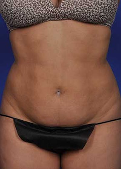 Liposuction and Smartlipo Before & After Gallery - Patient 5883278 - Image 1