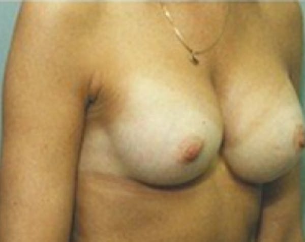 Breast Augmentation Before & After Gallery - Patient 5883279 - Image 2