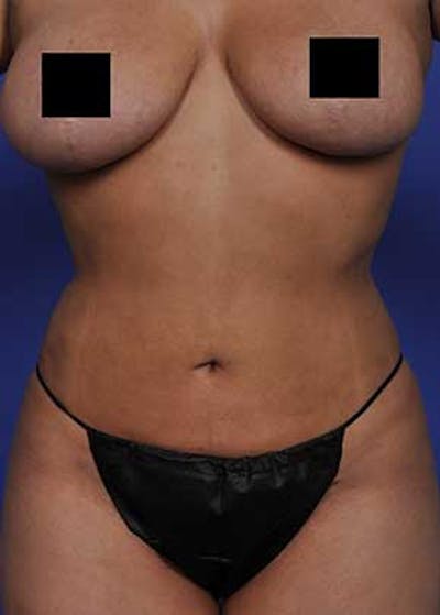 Liposuction and Smartlipo Before & After Gallery - Patient 5883278 - Image 2