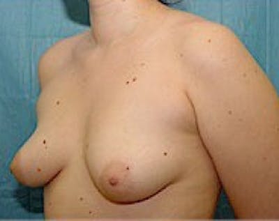 Breast Augmentation Before & After Gallery - Patient 5883284 - Image 1