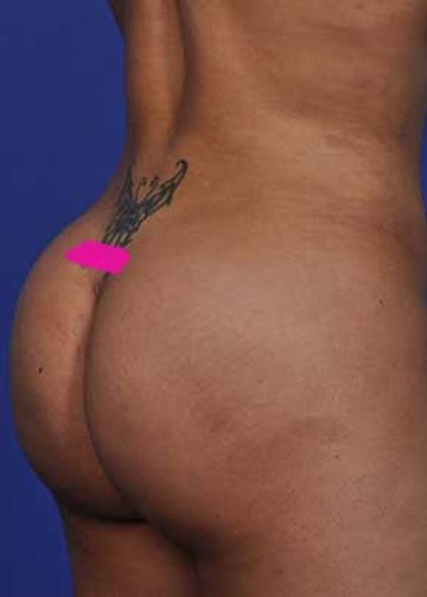 Liposuction and Smartlipo Before & After Gallery - Patient 5883282 - Image 2