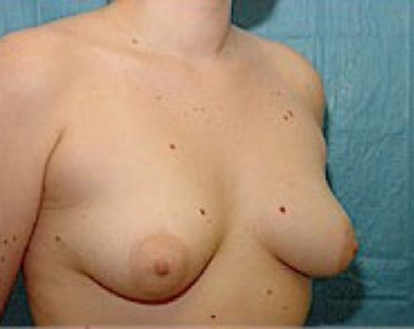 Breast Augmentation Before & After Gallery - Patient 5883284 - Image 3