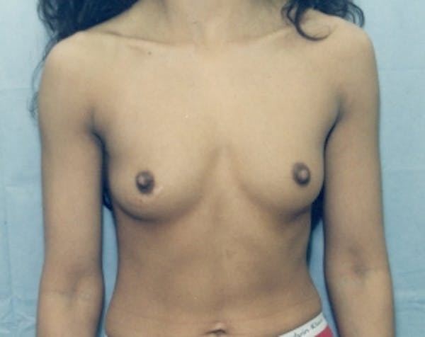Breast Augmentation Before & After Gallery - Patient 5883291 - Image 1