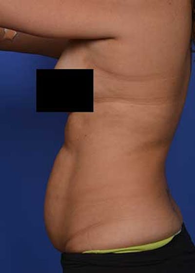Liposuction and Smartlipo Before & After Gallery - Patient 5883296 - Image 1