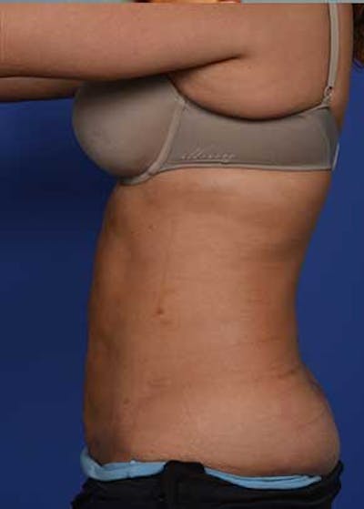Liposuction and Smartlipo Gallery - Patient 5883296 - Image 2