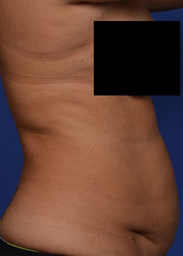 Liposuction and Smartlipo Gallery - Patient 5883296 - Image 3