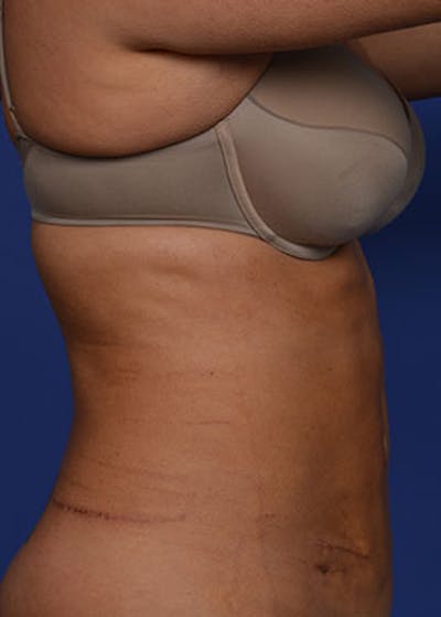 Liposuction and Smartlipo Before & After Gallery - Patient 5883296 - Image 4
