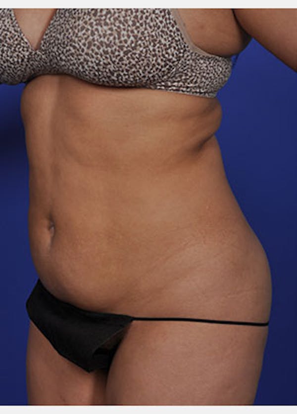 Liposuction and Smartlipo Gallery - Patient 5883303 - Image 1