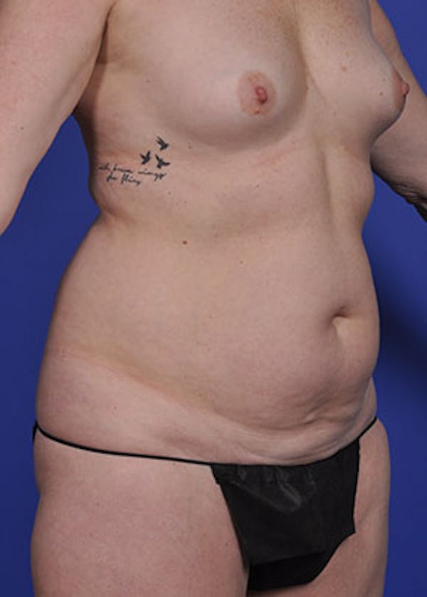 Liposuction and Smartlipo Before & After Gallery - Patient 5883305 - Image 3
