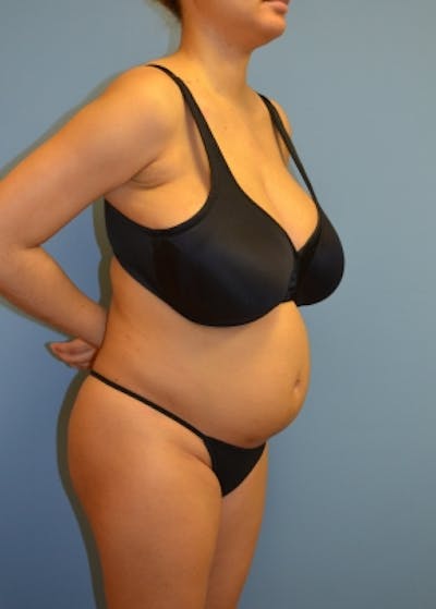 Liposuction and Smartlipo Gallery - Patient 5883308 - Image 1