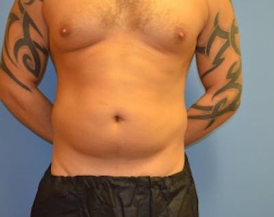 Liposuction and Smartlipo Before & After Gallery - Patient 5883310 - Image 1