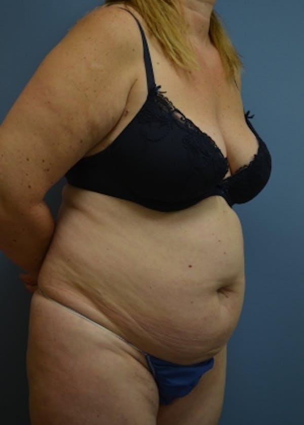 Liposuction and Smartlipo Before & After Gallery - Patient 5883314 - Image 1