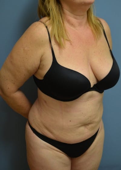 Liposuction and Smartlipo Before & After Gallery - Patient 5883314 - Image 2