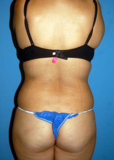 Liposuction and Smartlipo Gallery - Patient 5883315 - Image 1