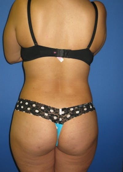 Liposuction and Smartlipo Gallery - Patient 5883315 - Image 2