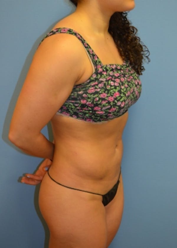 Liposuction and Smartlipo Gallery - Patient 5883316 - Image 2