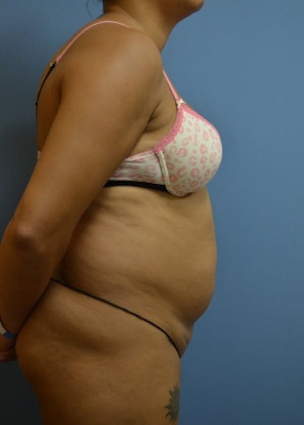 Liposuction and Smartlipo Before & After Gallery - Patient 5883317 - Image 1