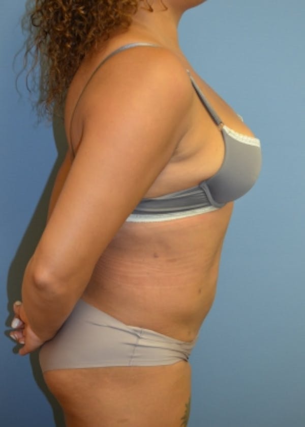 Liposuction and Smartlipo Before & After Gallery - Patient 5883317 - Image 2
