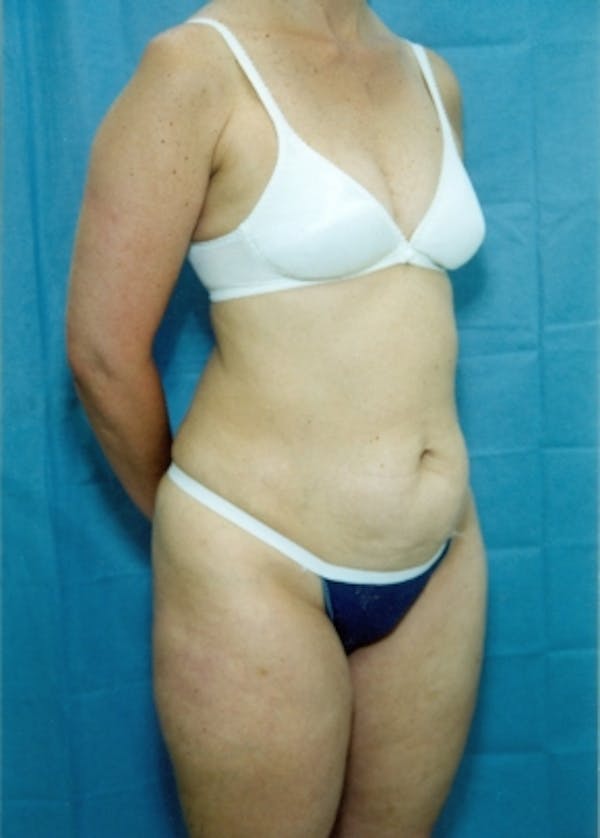Liposuction and Smartlipo Before & After Gallery - Patient 5883318 - Image 1