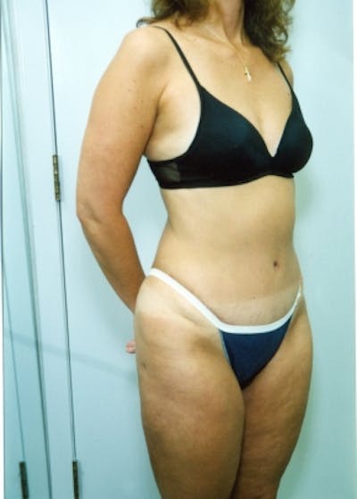 Liposuction and Smartlipo Gallery - Patient 5883318 - Image 2