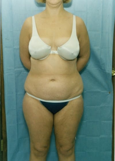 Liposuction and Smartlipo Before & After Gallery - Patient 5883320 - Image 1