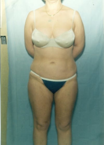 Liposuction and Smartlipo Gallery - Patient 5883320 - Image 2