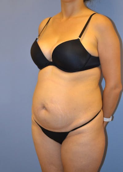 Tummy Tuck Before & After Gallery - Patient 5883321 - Image 1