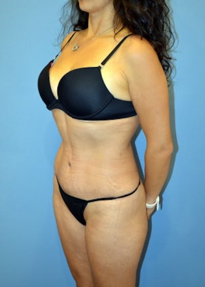 Tummy Tuck Before & After Gallery - Patient 5883321 - Image 2