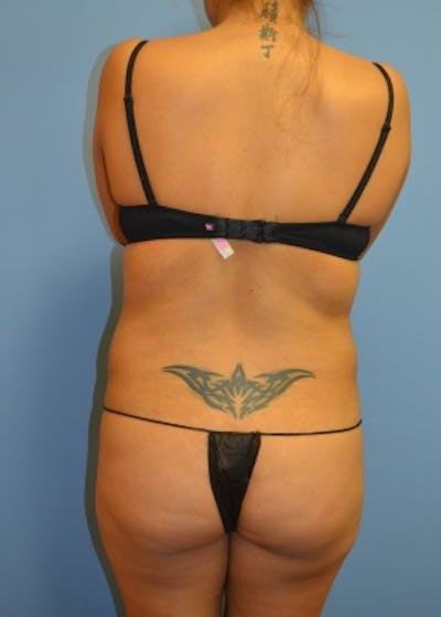 Liposuction and Smartlipo Before & After Gallery - Patient 5883322 - Image 1
