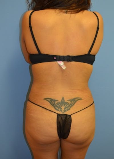 Liposuction and Smartlipo Before & After Gallery - Patient 5883322 - Image 2