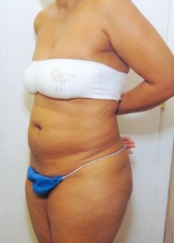 Tummy Tuck Before & After Gallery - Patient 5883323 - Image 1