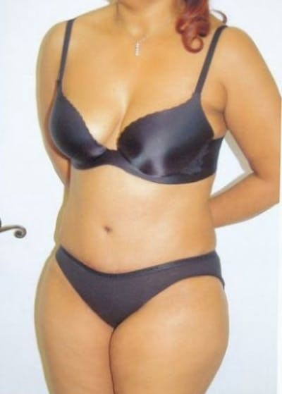 Tummy Tuck Before & After Gallery - Patient 5883323 - Image 2